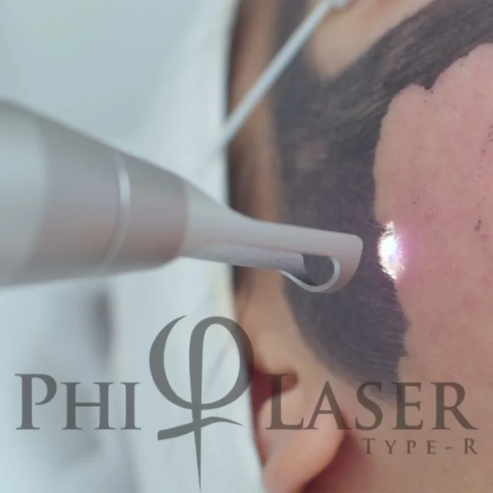 Carbon Laser Peel