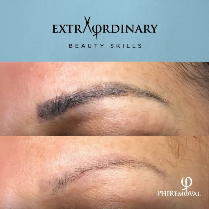PhiRemoval – Safe, Non-Laser Tattoo & PMU Removal